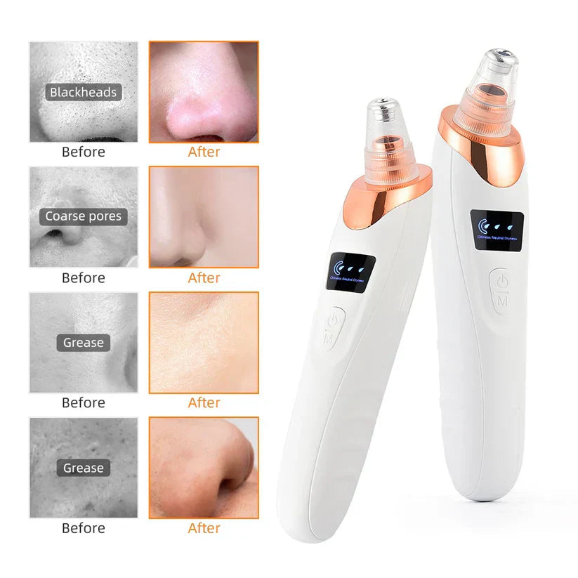 5 IN 1 Blackheads Remover Vacuum Rechargable